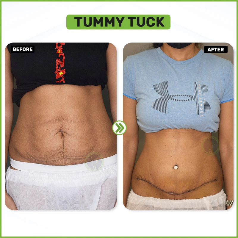tummy tuck before and after 