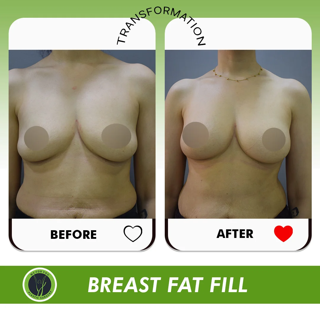 Before and After 3