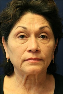 Before treatment