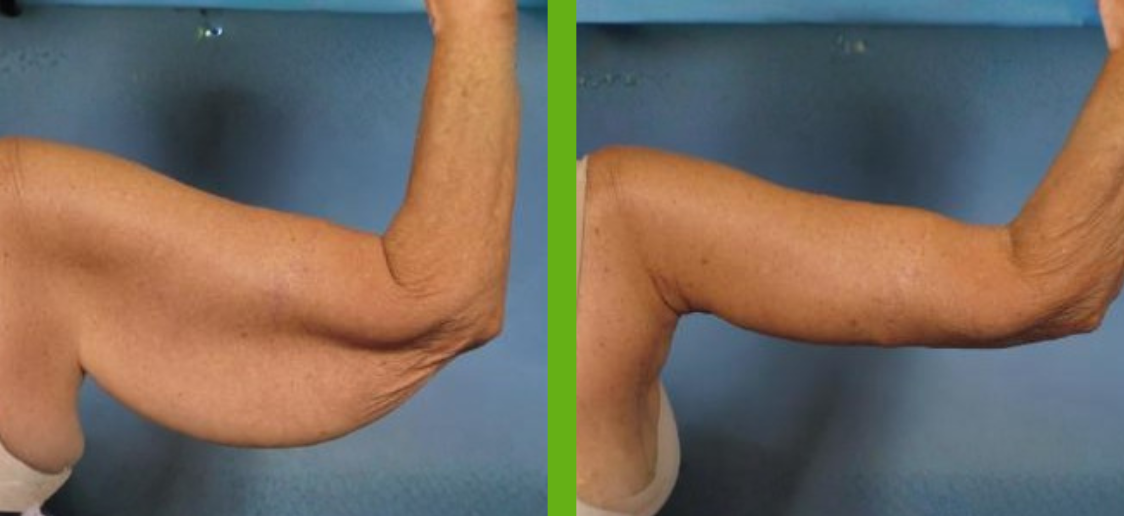 Arm Lift