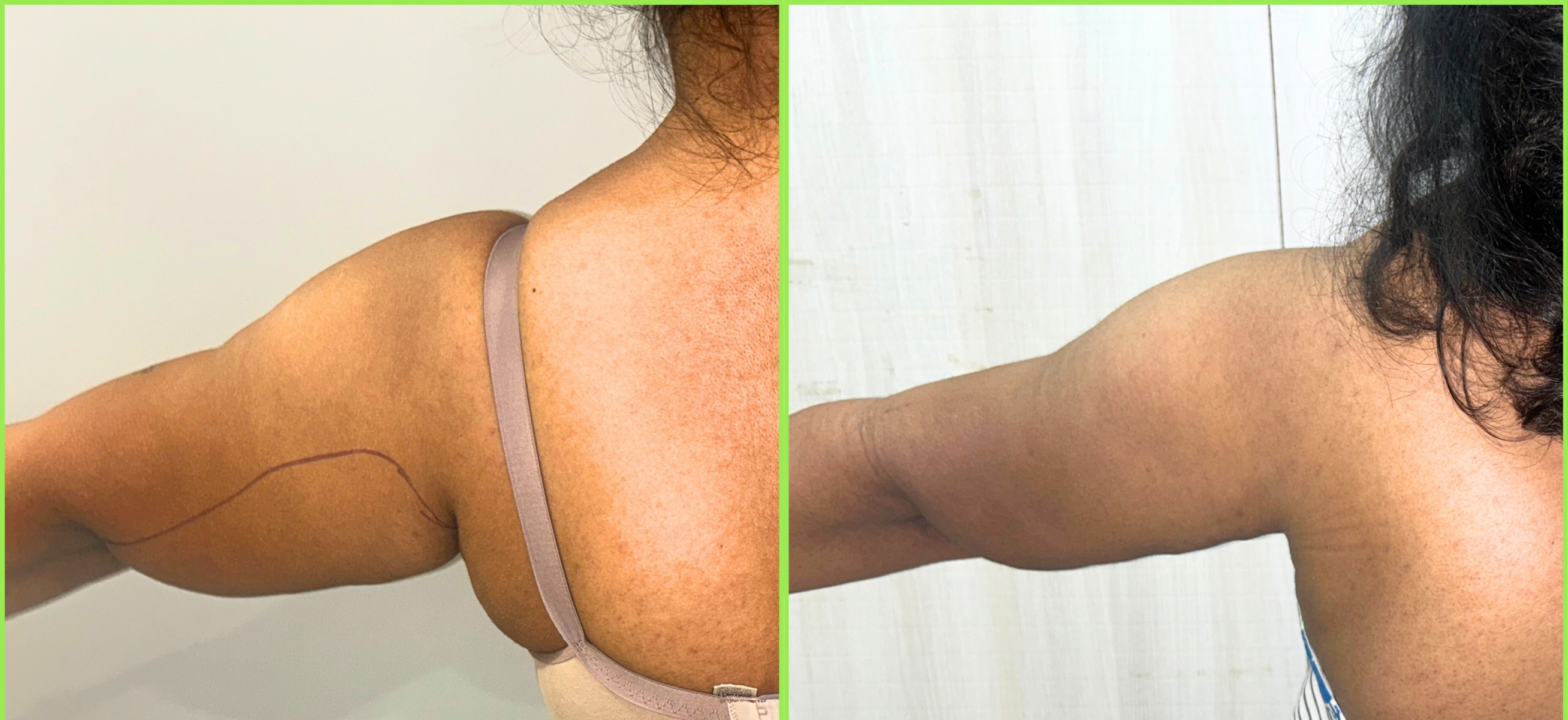 Liposuction - Thigh, Arm, Chin