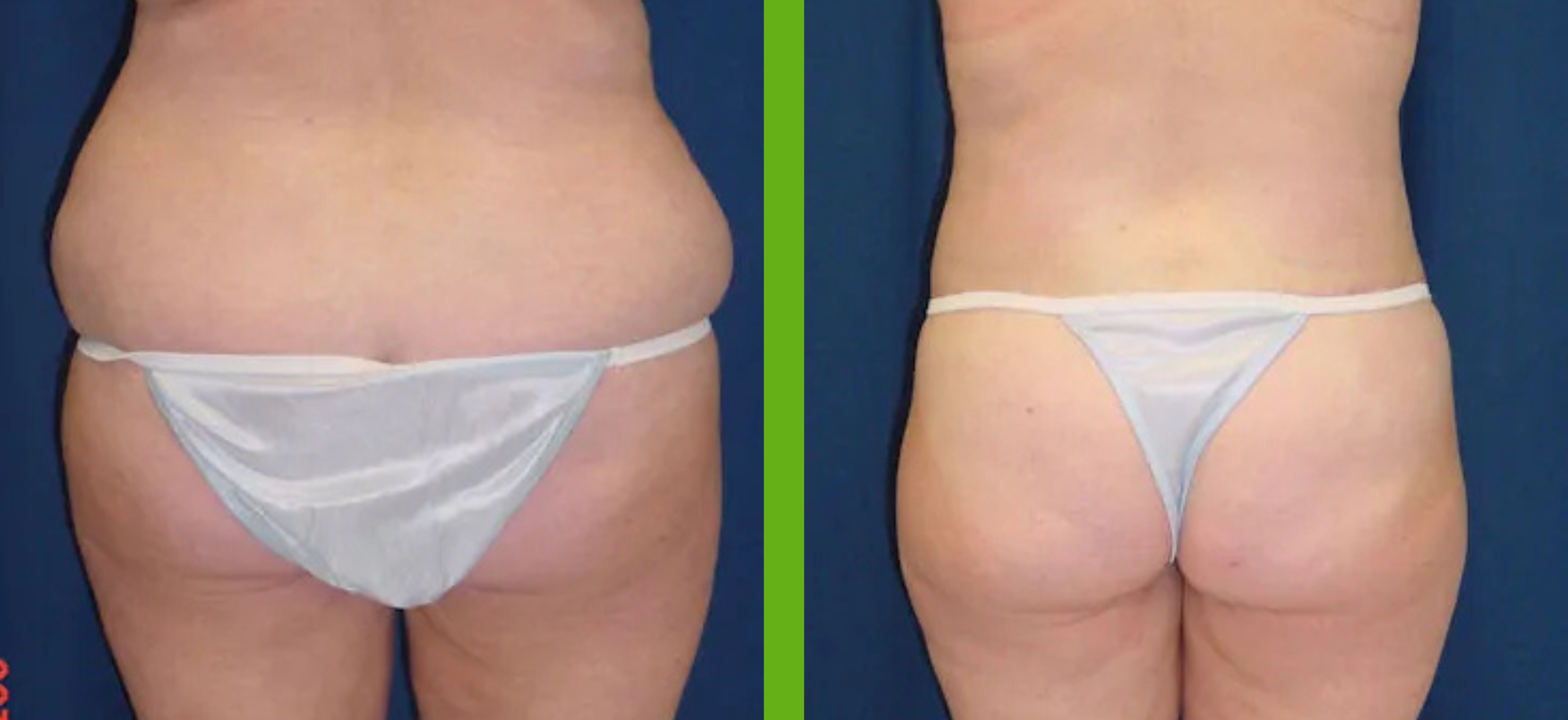 Belt Lipectomy