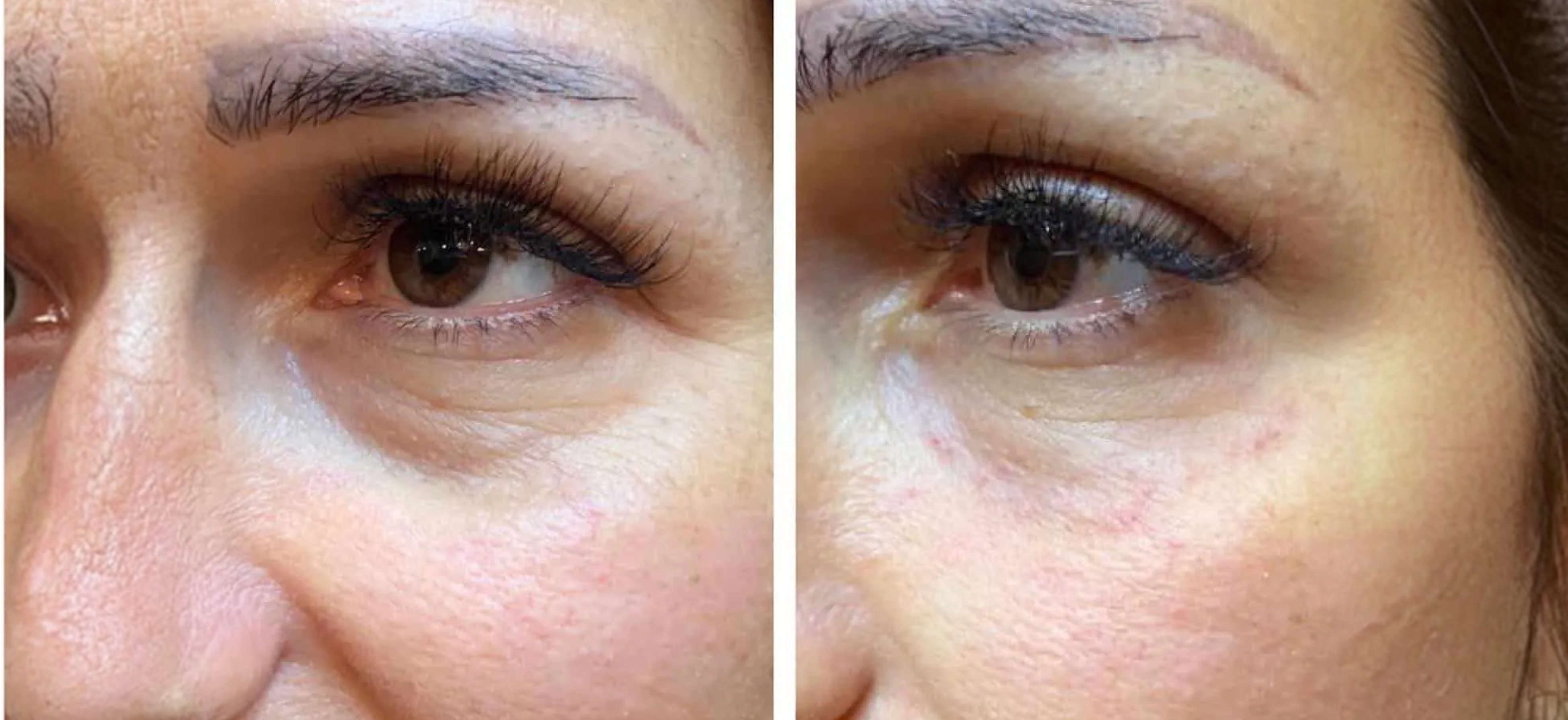 Botox injections