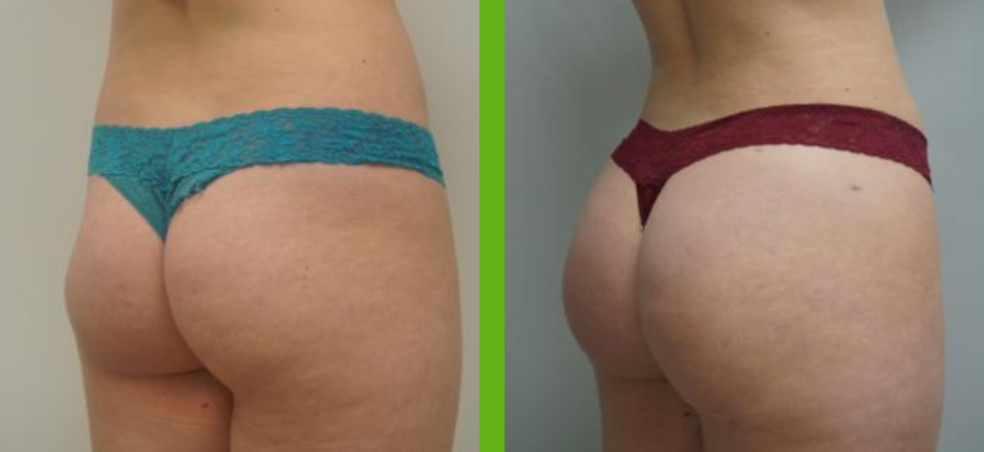 Brazilian Butt Lift