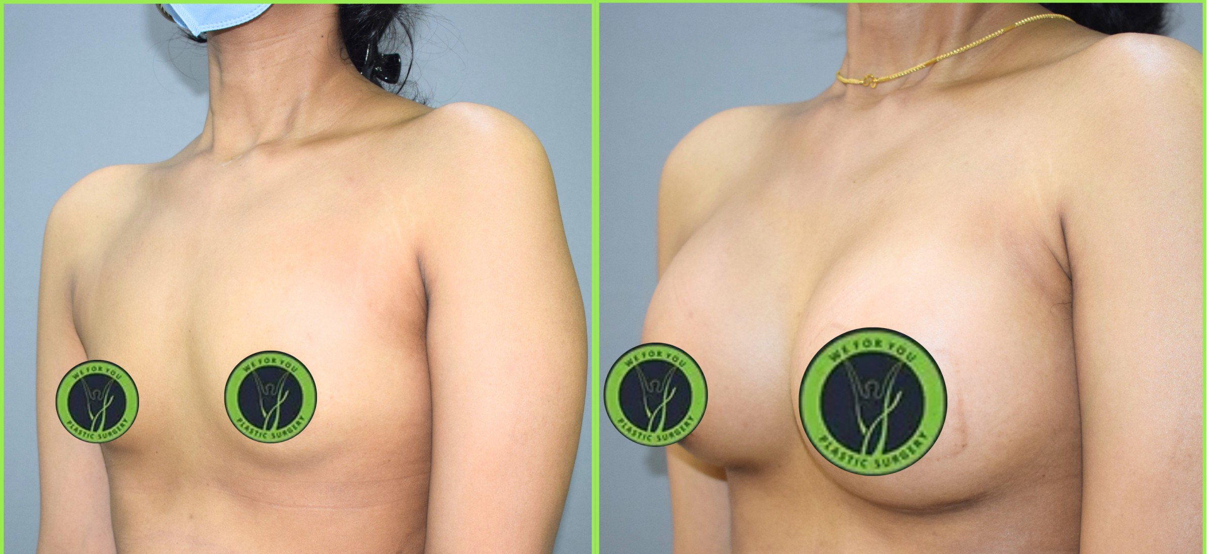Breast Augmentation / Implant