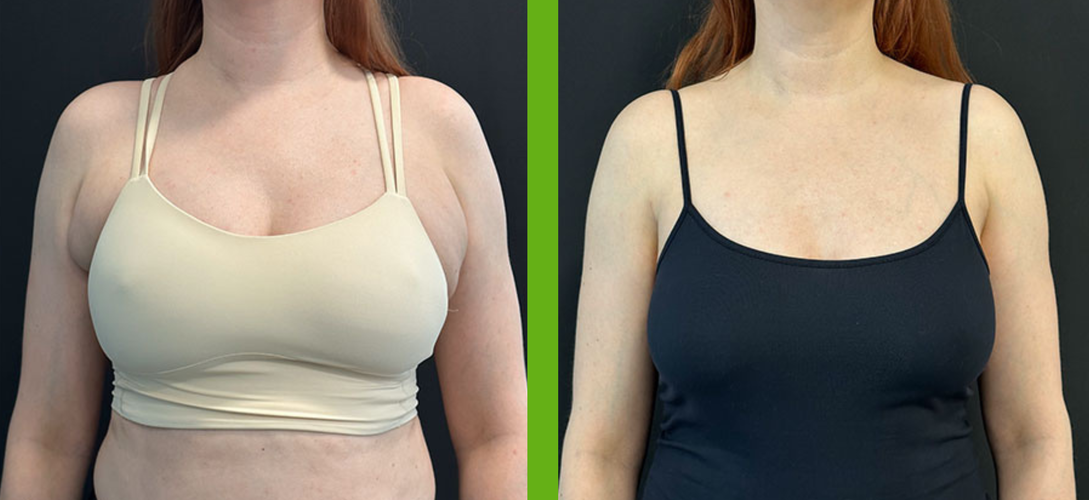 Breast / Axillary Breast Fat Pad