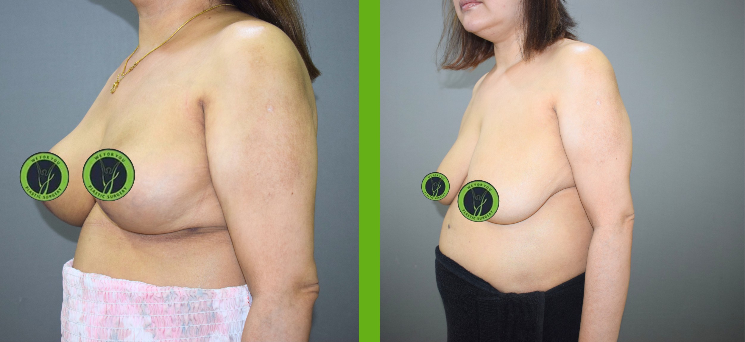 Breast Reduction