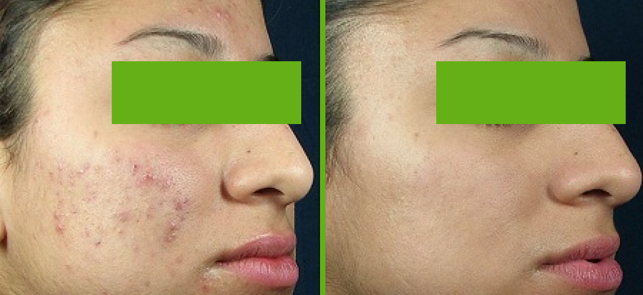 Chemical Peels