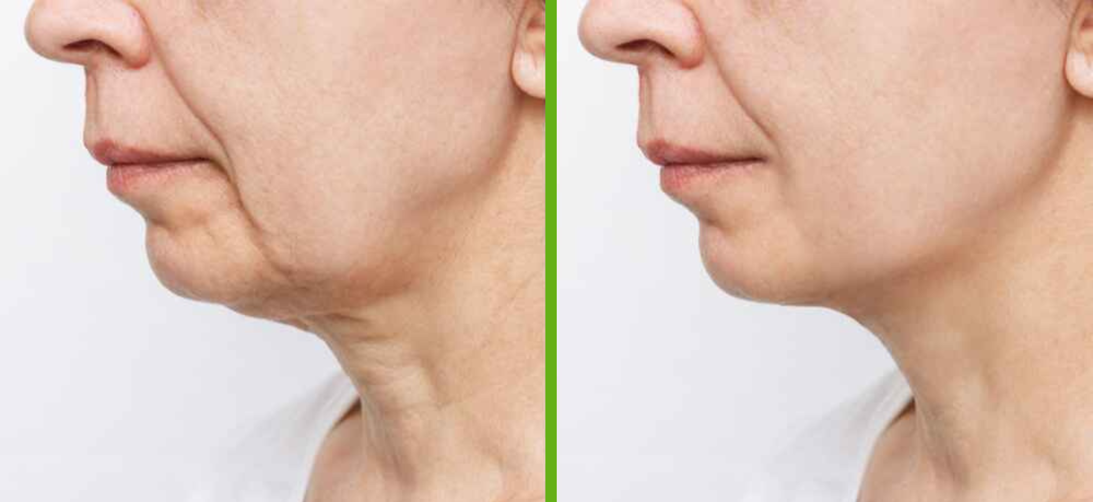 Chin Augmentation
