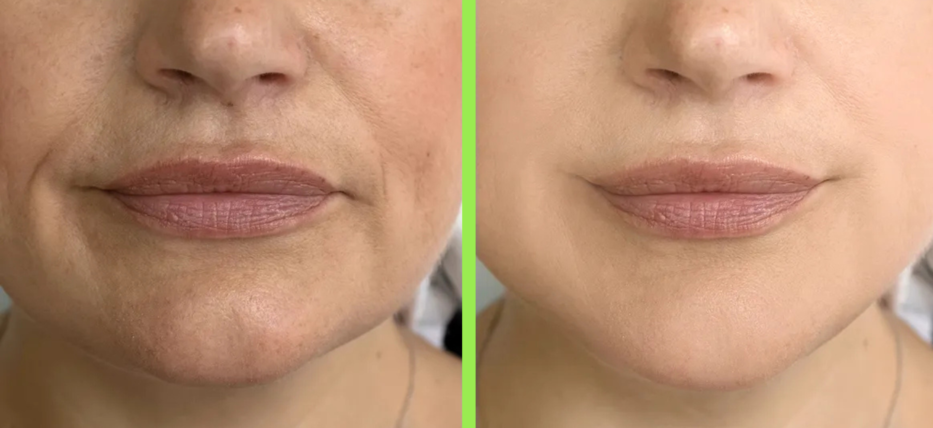 Dermal Fillers