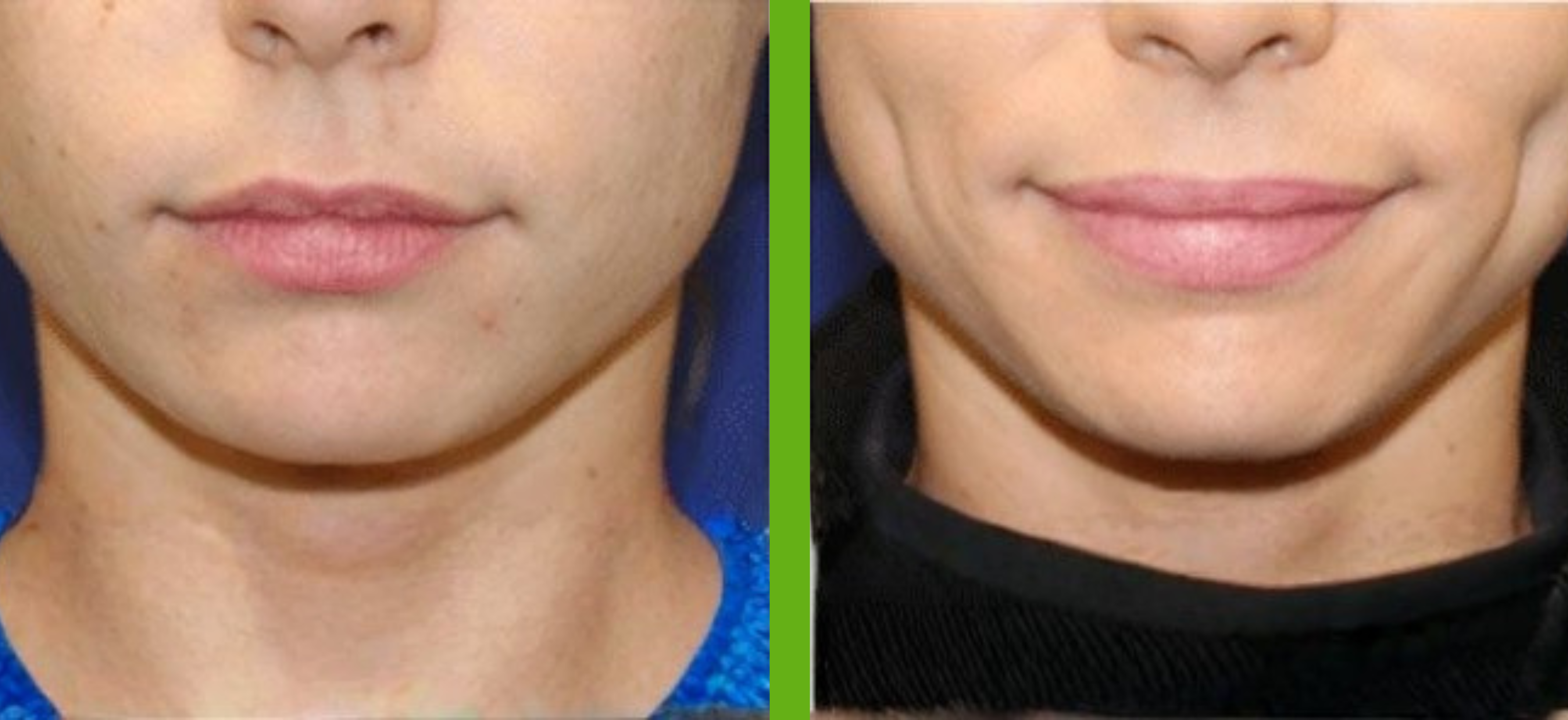Dimple Creation