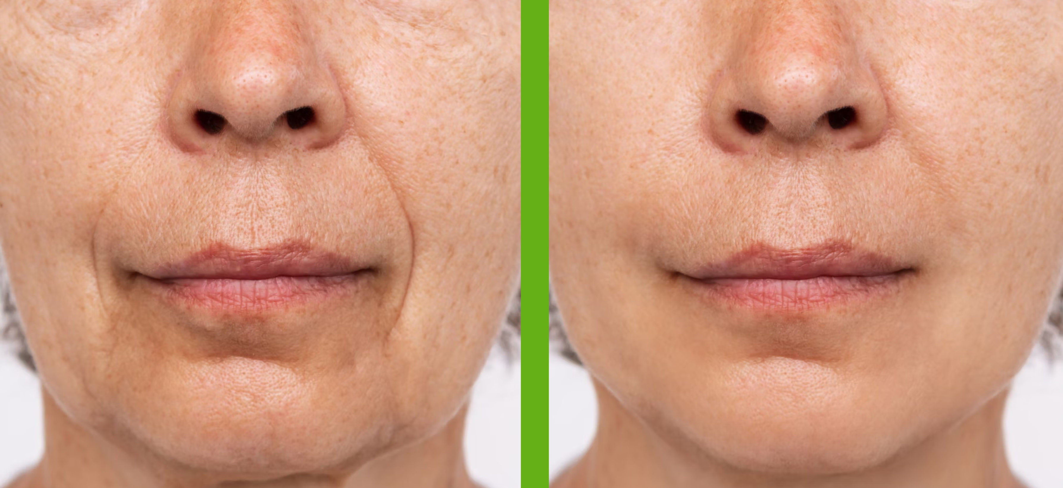 Facial Fat Grafting