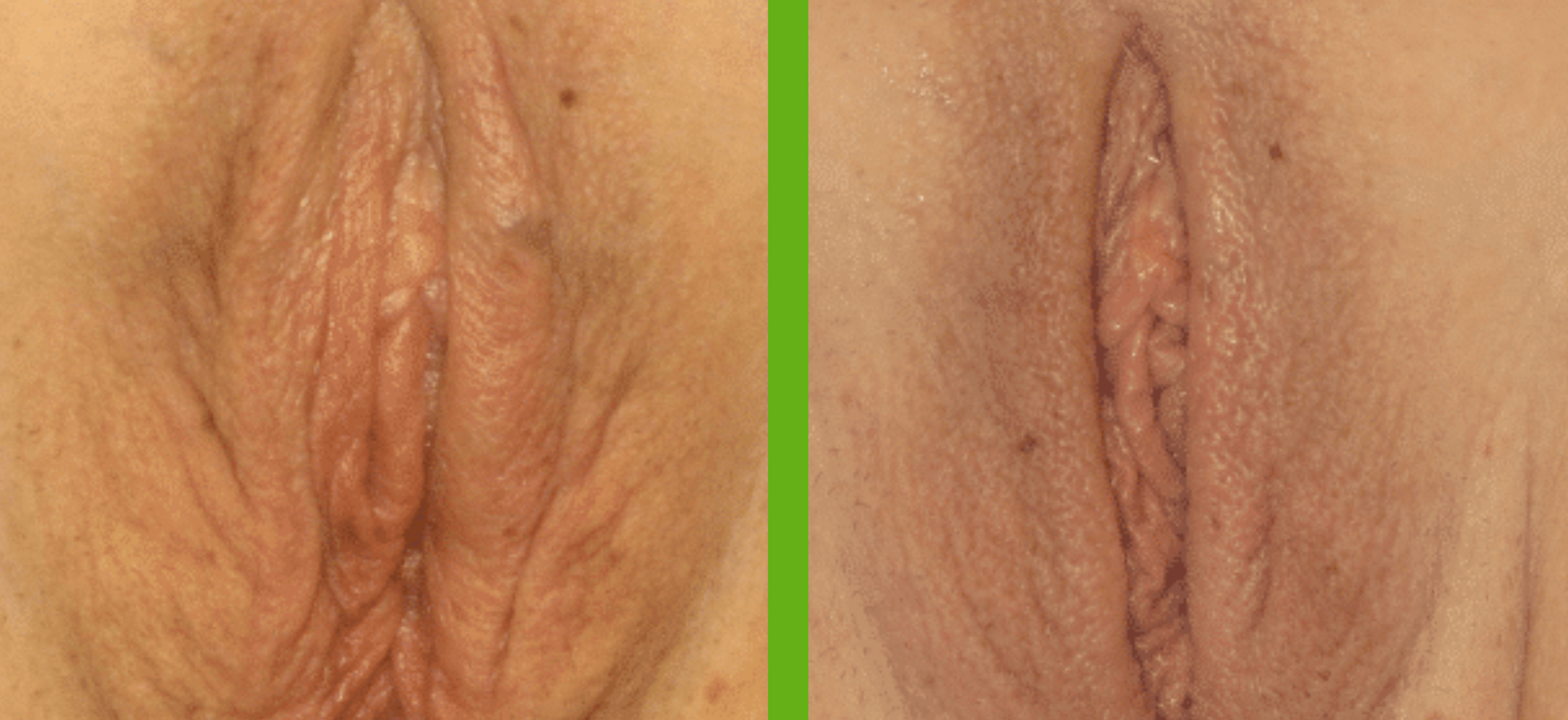 Female Genital Surgery