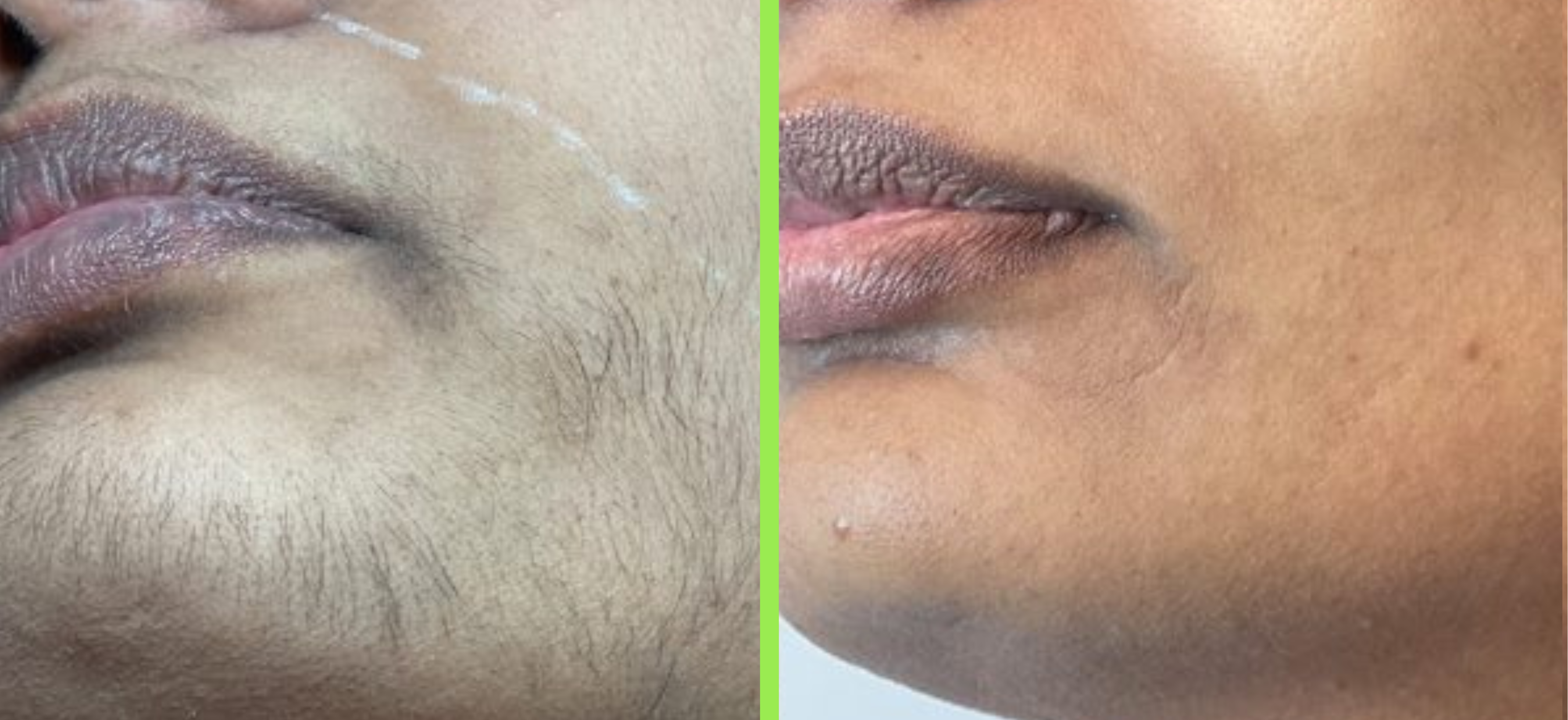 Laser hair reduction