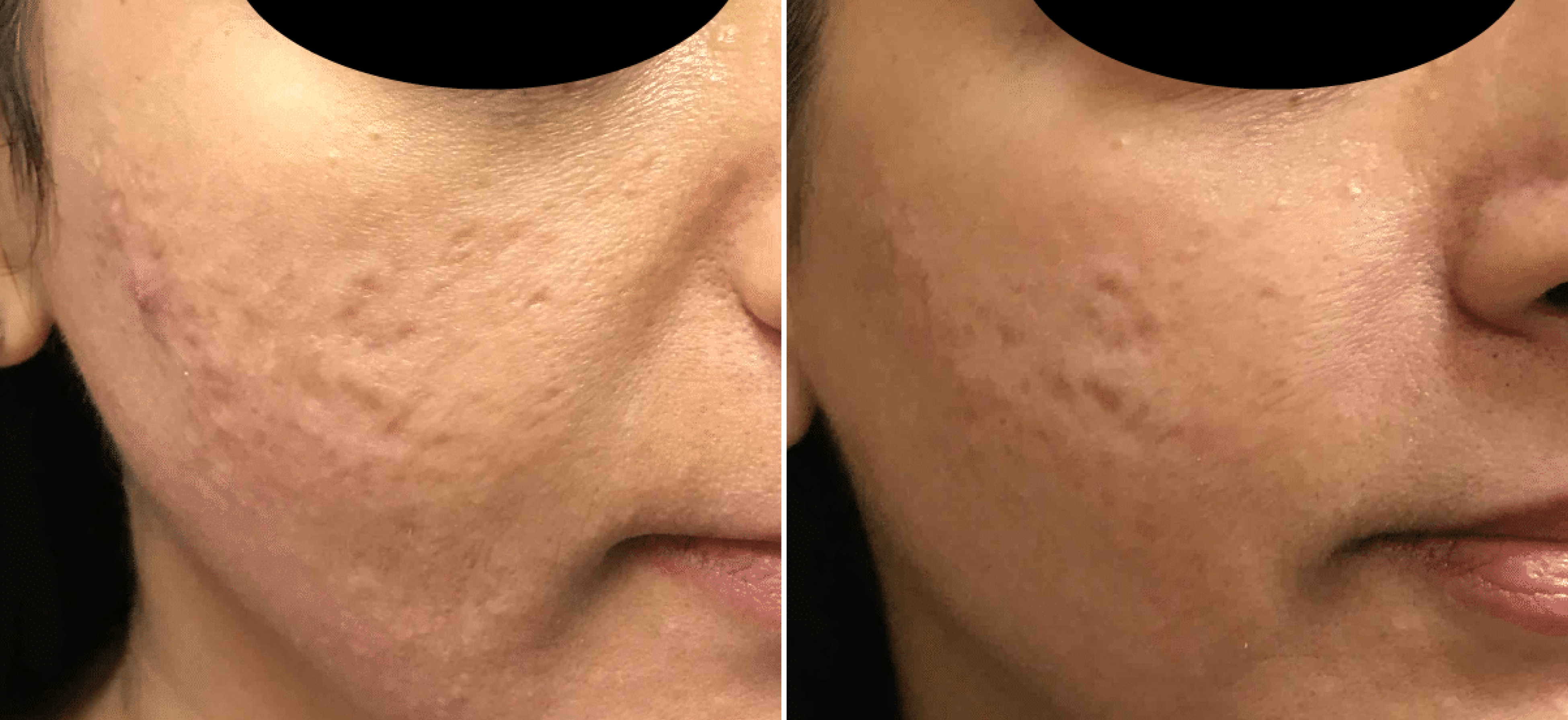 Microneedling