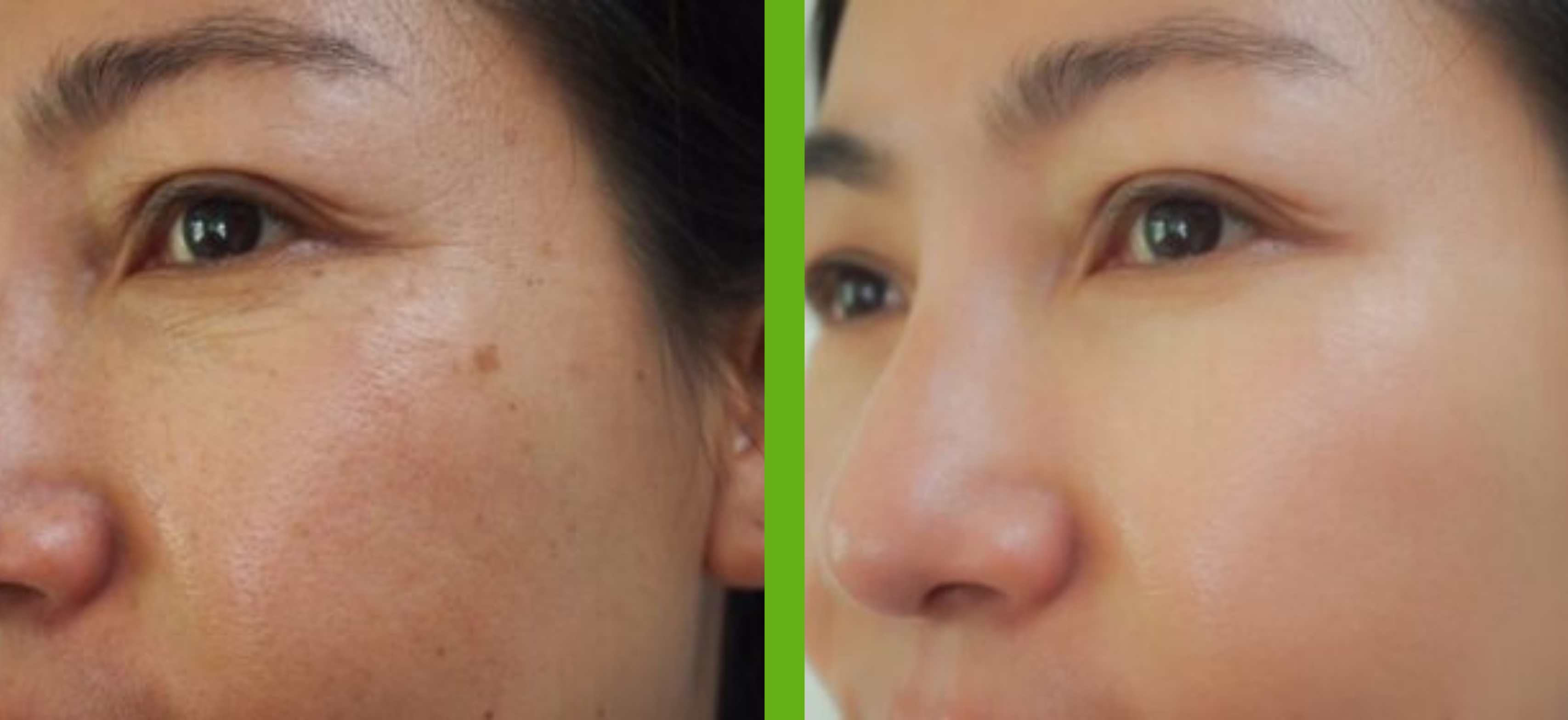 Mesotherapy