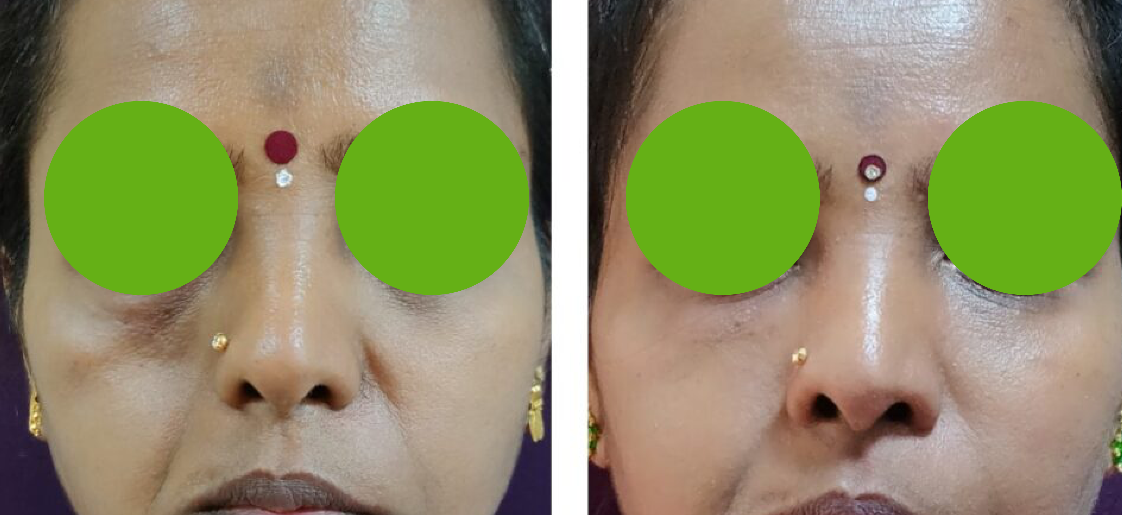 Nano Fat Grafting