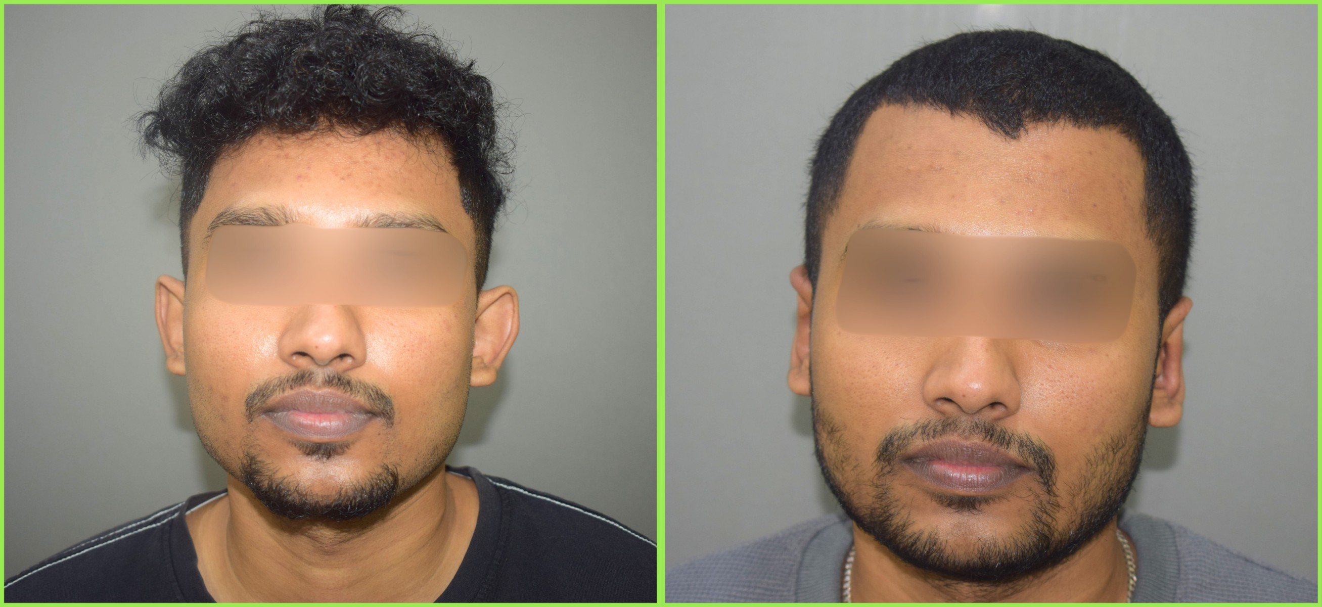 Otoplasty