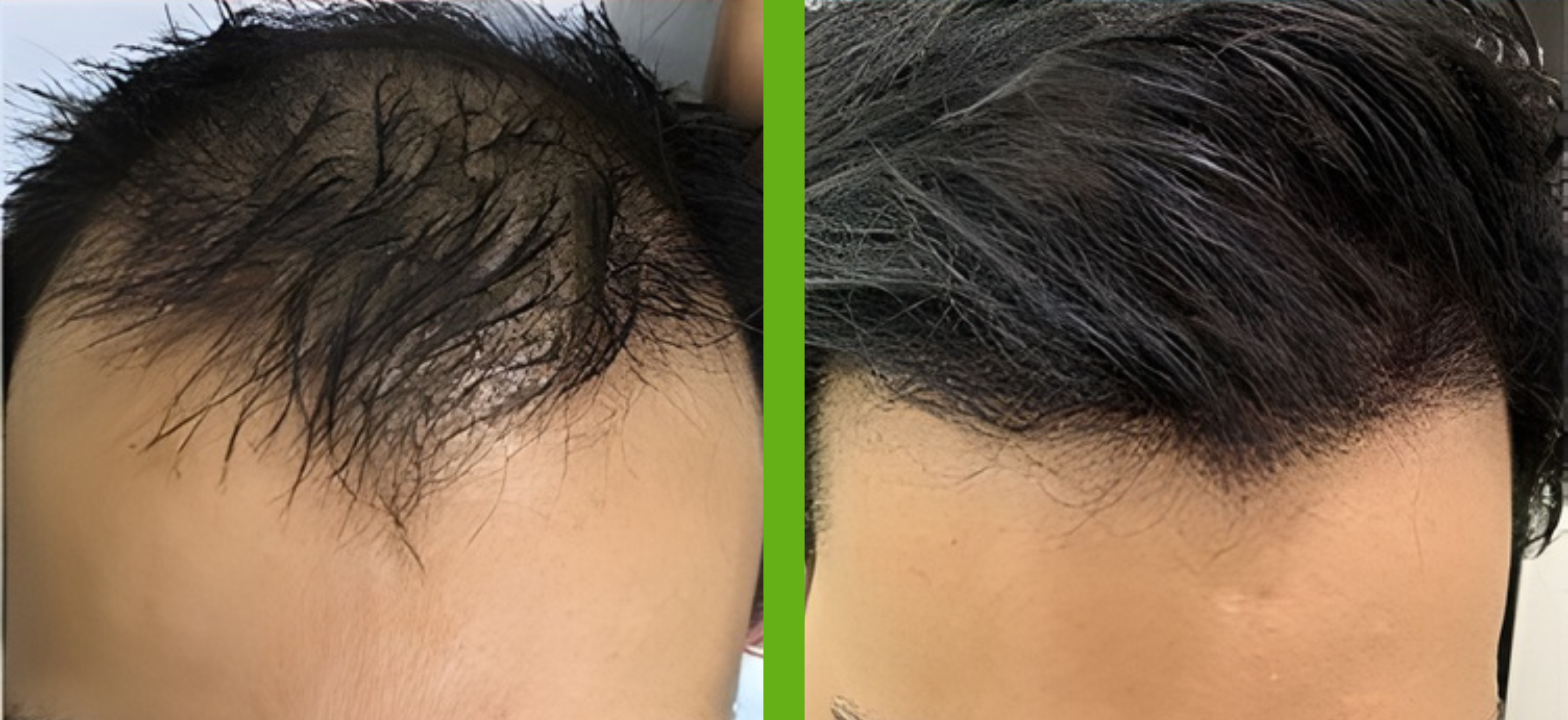 PRP (Platelet-Rich Plasma)