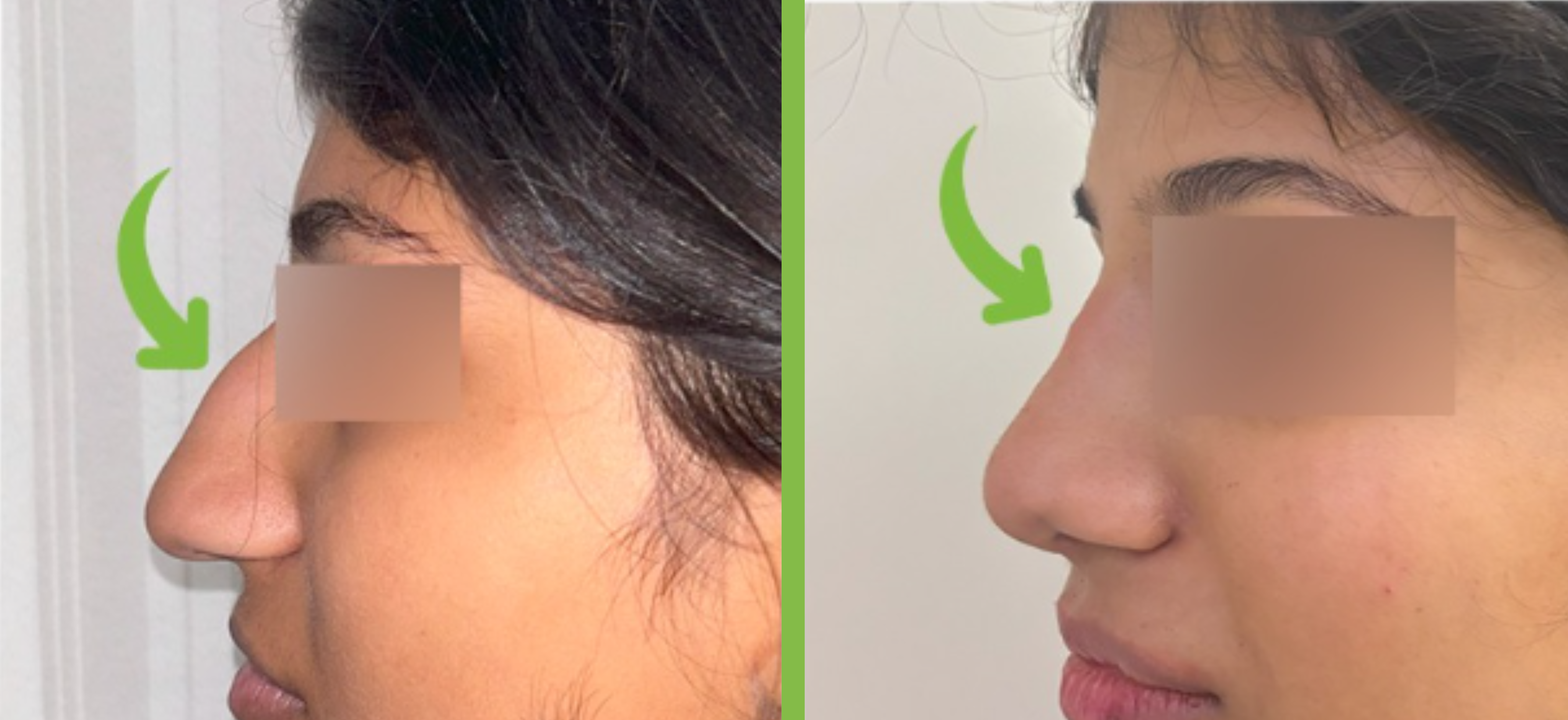 Rhinoplasty