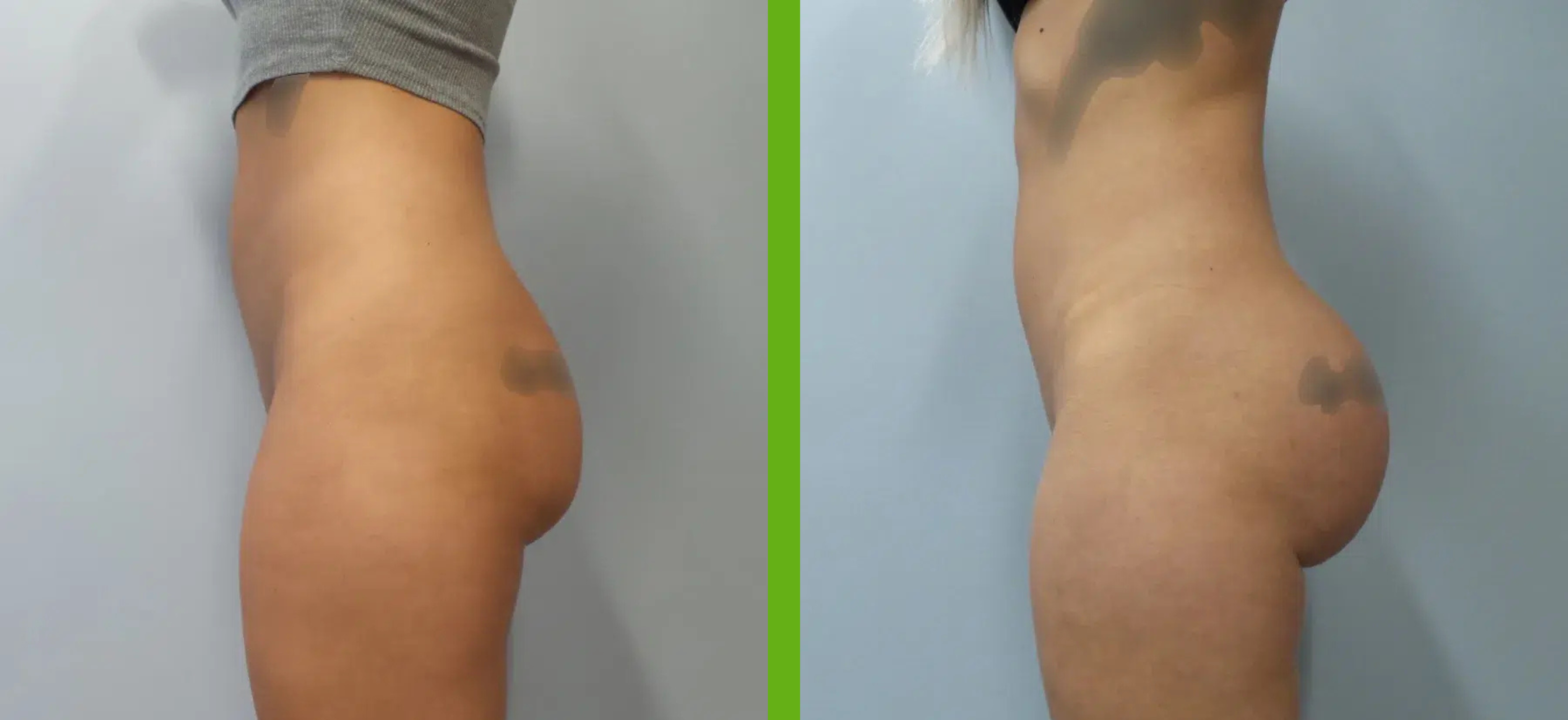 Silicon Butt Implant