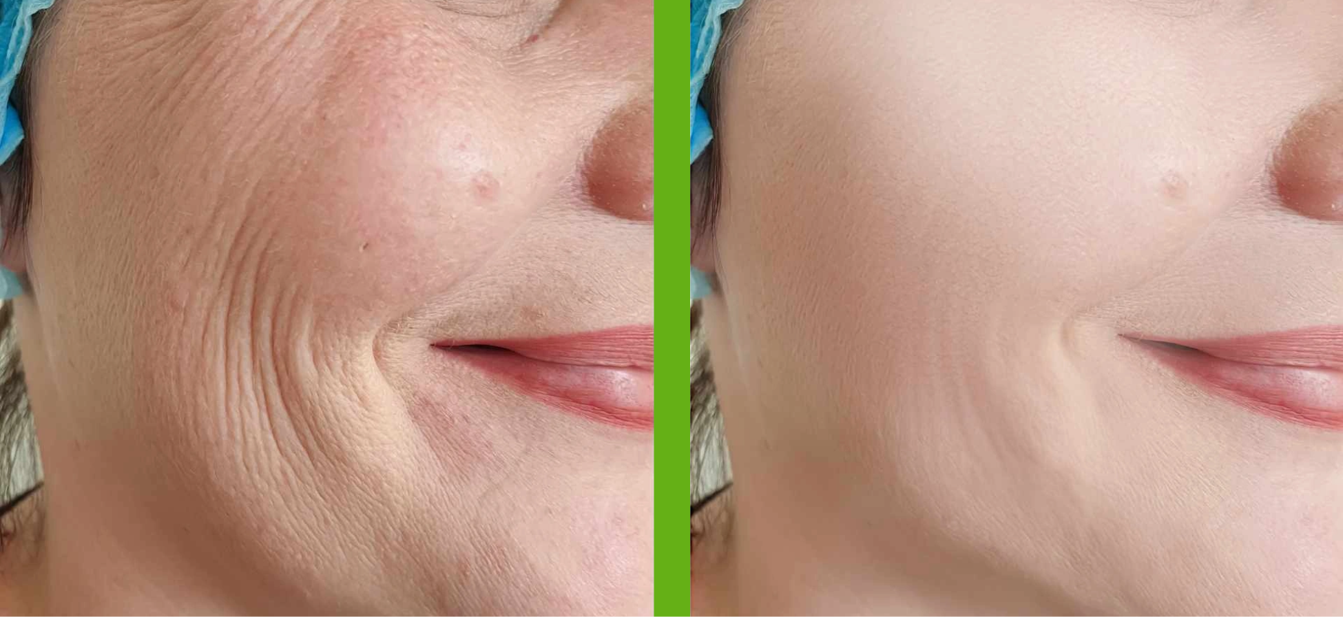 Skin Boosters treatment