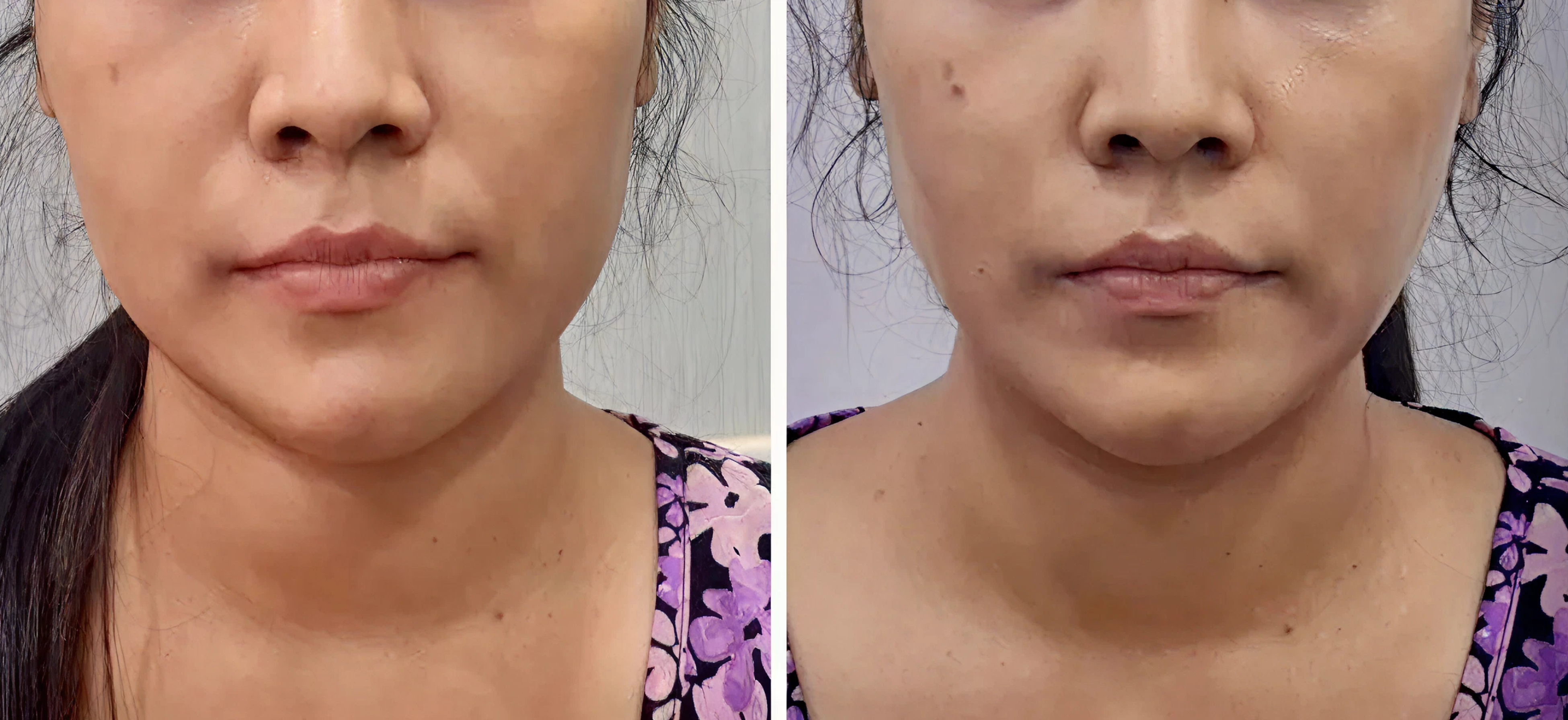 Threadlift treatment