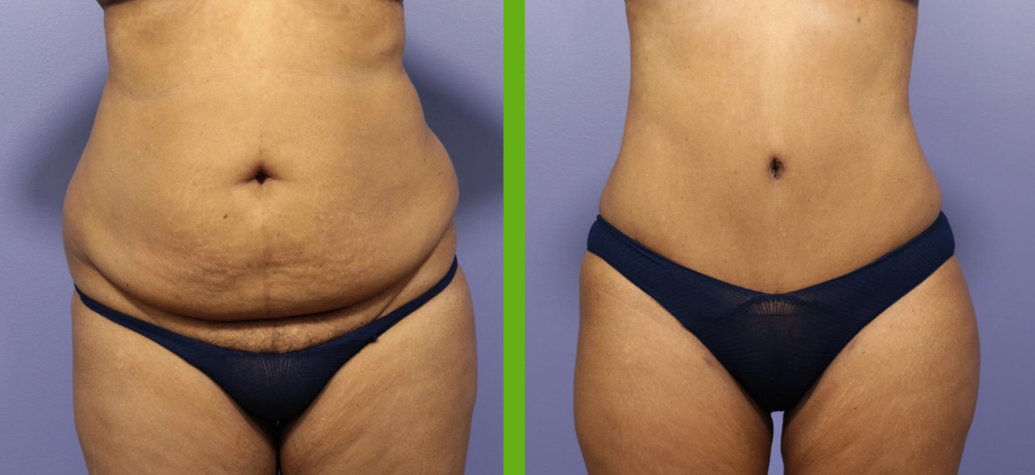 Tummy Tuck