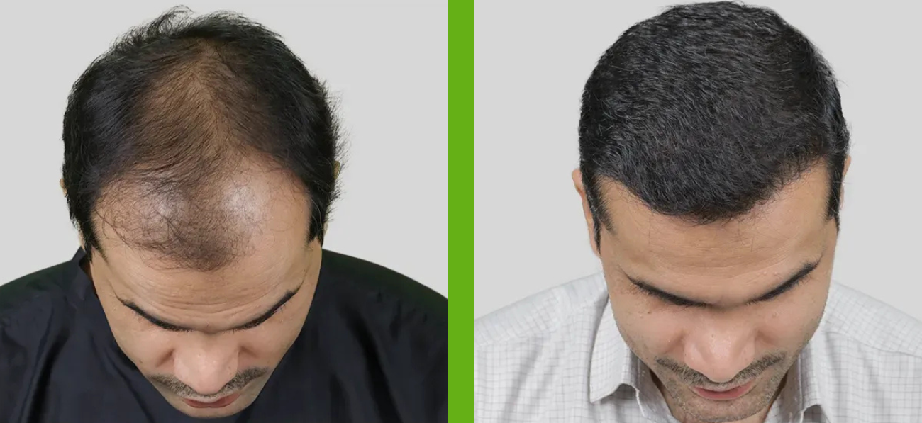 Hair Transplant