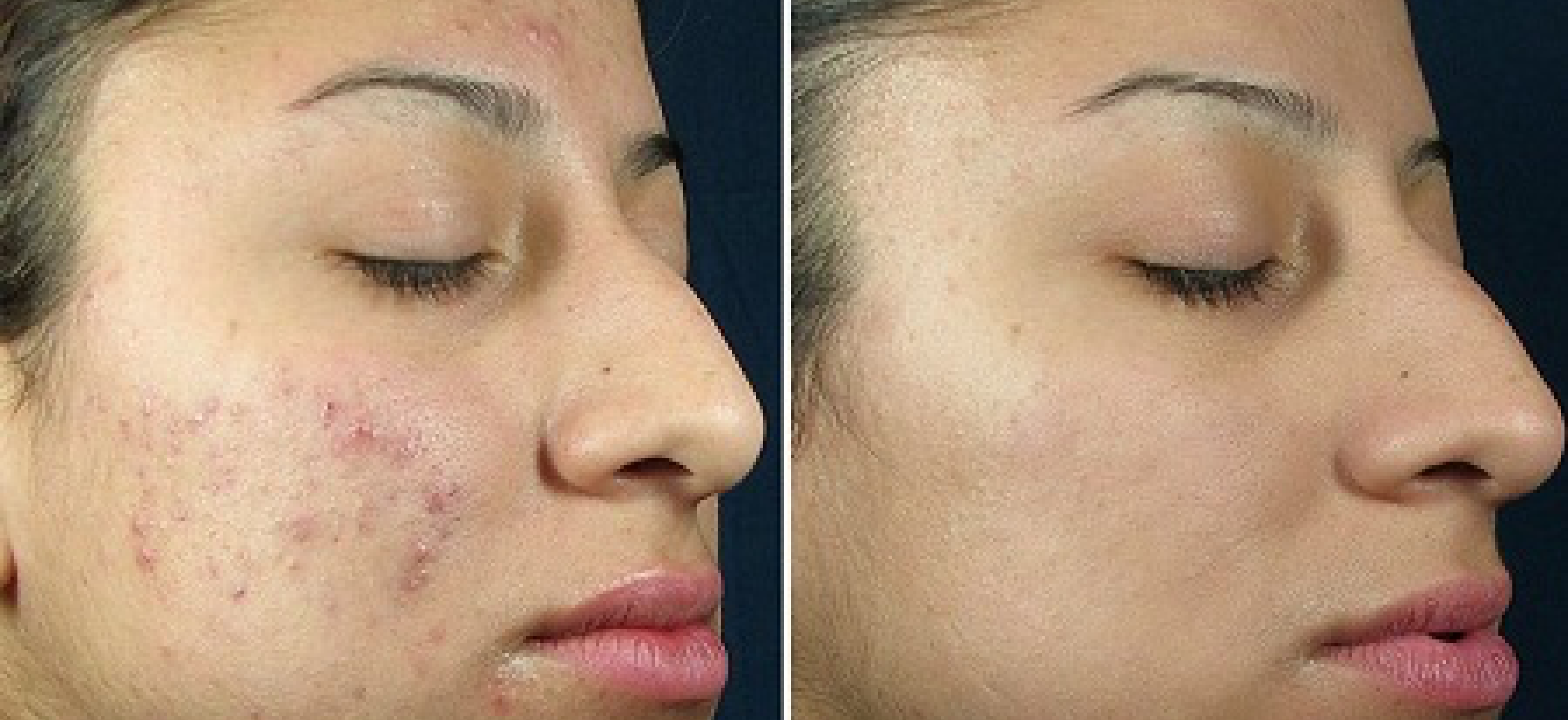 Hydrafacial