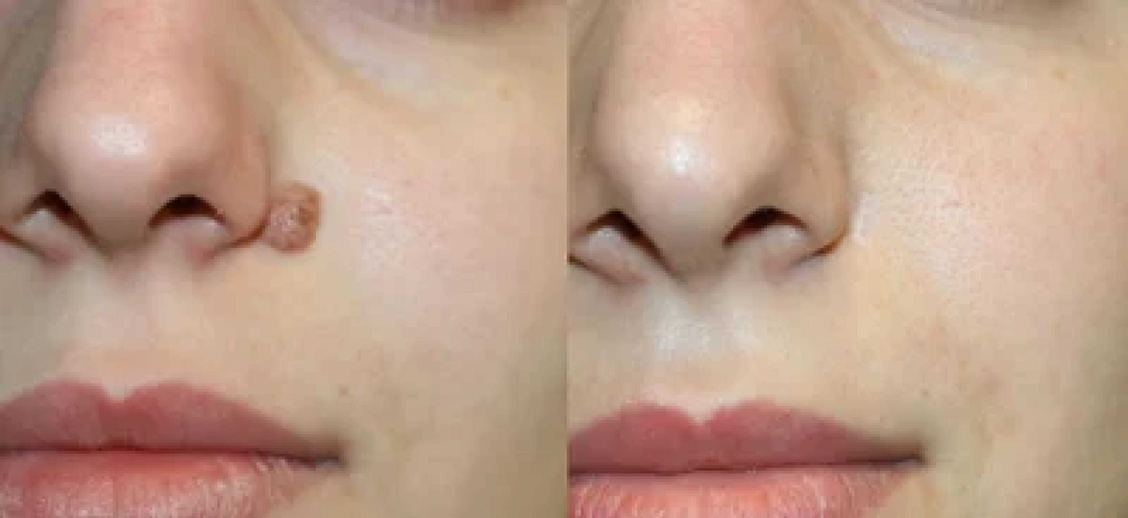 Mole Removal treatment