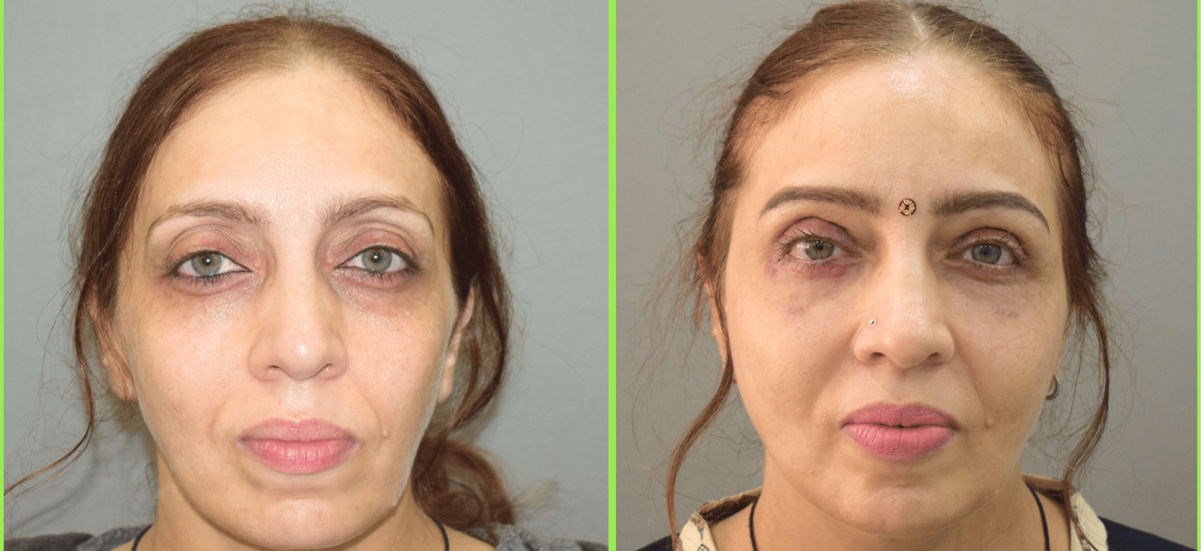 Blepharoplasty