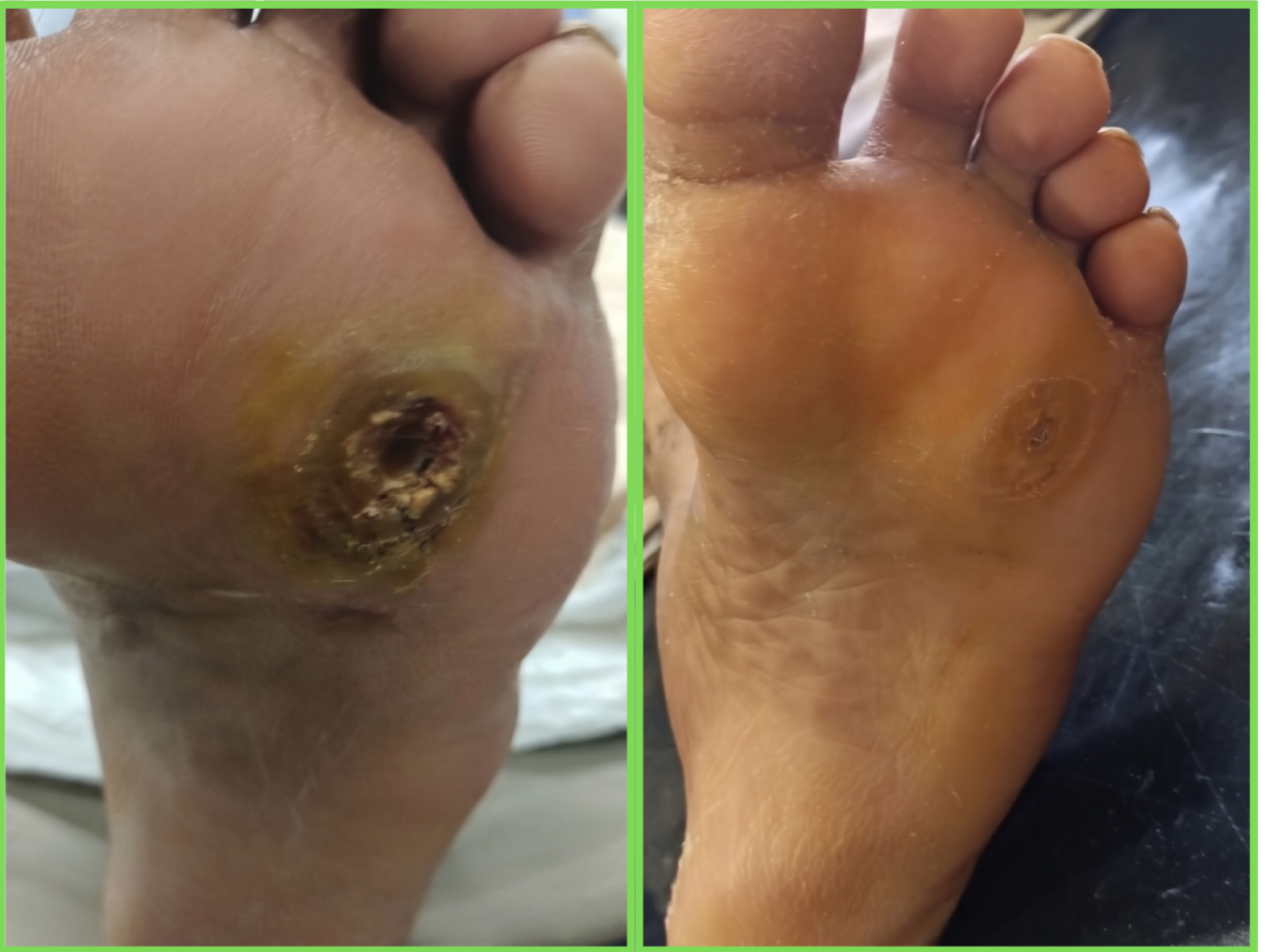 Diabetic Foot