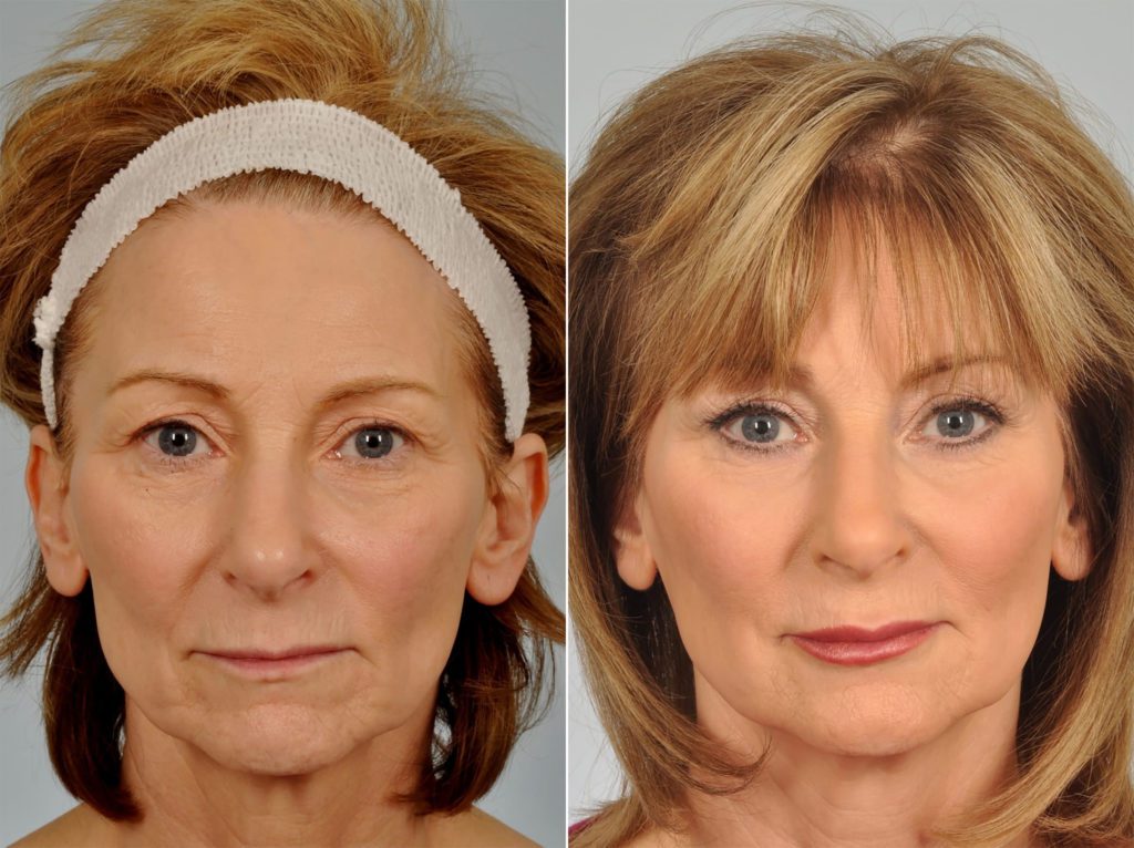 Blepharoplasty
