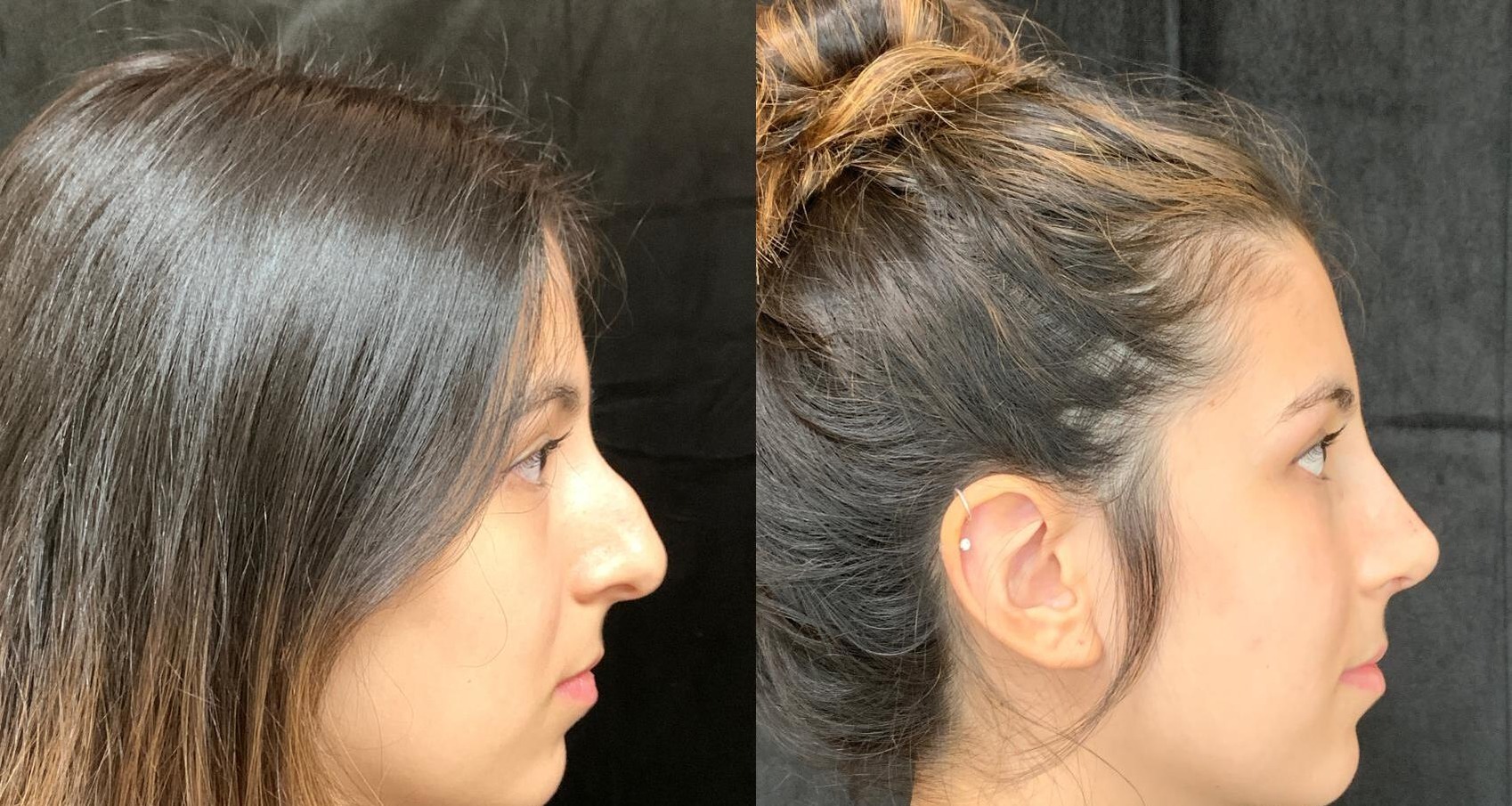 Rhinoplasty